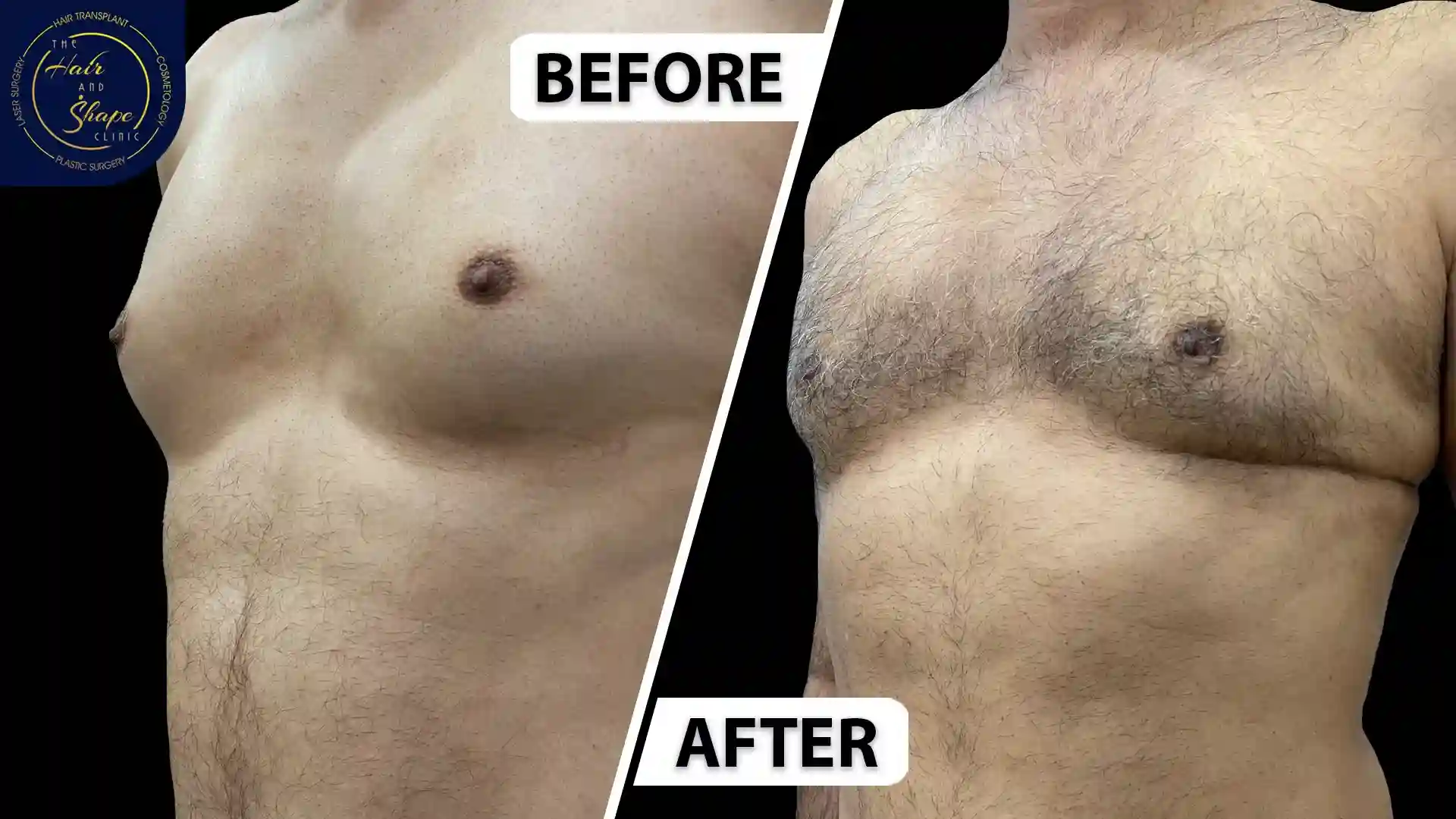 Gynecomastia result